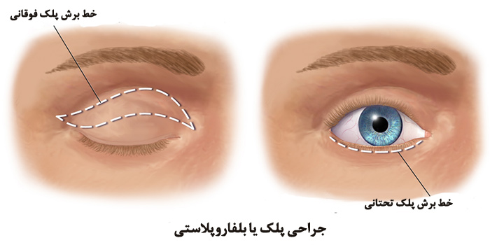 بلفاروپلاستی